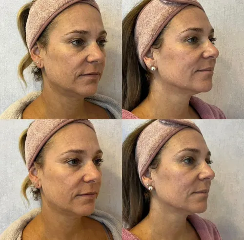 Resultado clínico de paciente — antes e depois