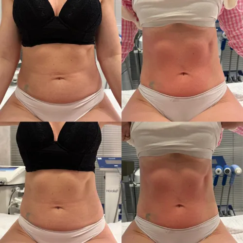 Resultado clínico de paciente — antes e depois