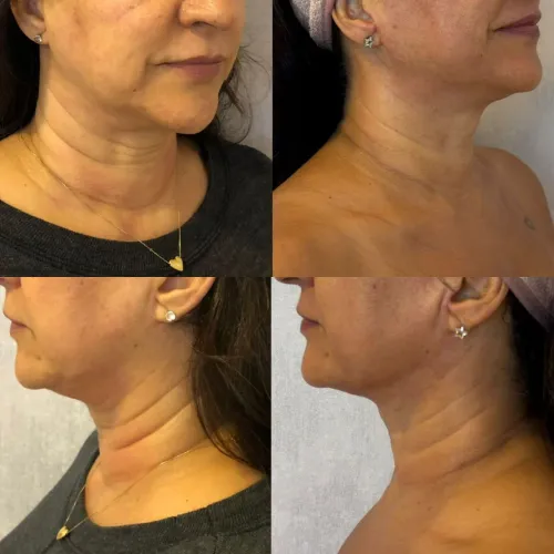 Resultado clínico de paciente — antes e depois